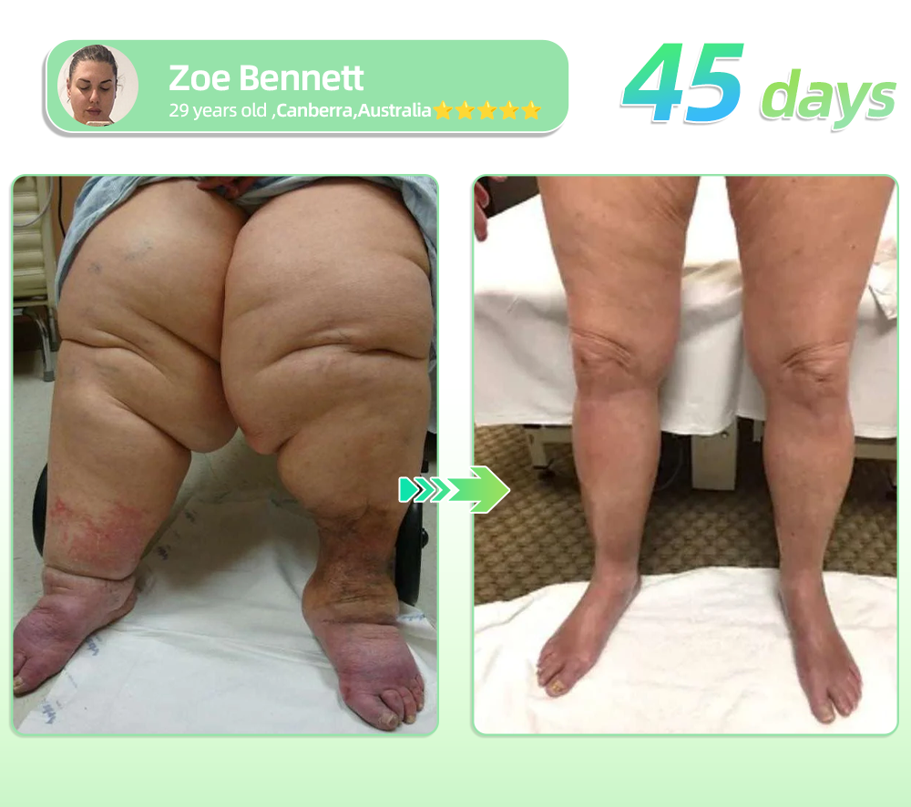 TotaI Body HeaIth Start Here 💧𝖯𝗂𝗀𝗎𝗂𝖺𝗒® 𝖦𝖫𝖯-𝟣 𝖶𝖾𝗂𝗀𝗁𝗍 𝖫𝗈𝗌𝗌 𝖮𝗋𝖺𝗅 𝖲𝗈𝗅𝗎𝗍𝗂𝗈𝗇 – 𝖮𝖻𝖾𝗌𝗂𝗍𝗒, 𝖢𝖺𝗋𝖽𝗂𝗈𝗏𝖺𝗌𝖼𝗎𝗅𝖺𝗋 𝖣𝗂𝗌𝖾𝖺𝗌𝖾𝗌, 𝖣𝗂𝖺𝖻𝖾𝗍𝖾𝗌, 𝖲𝗅𝖾𝖾𝗉 𝖠𝗉𝗇𝖾𝖺, 𝖩𝗈𝗂𝗇𝗍 𝖯𝗋𝗈𝖻𝗅𝖾𝗆𝗌 𝖺𝗇𝖽 𝖬𝗈𝗋𝖾💧